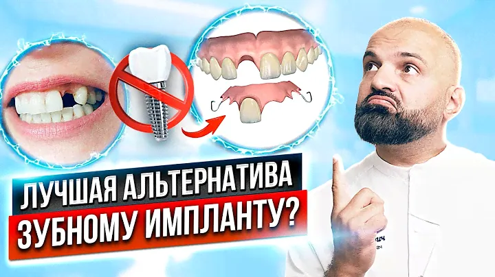 Чем заменить зубной имплант? Альтернатива имплантации зубов. Чем заменить имплант в 2024 году